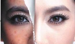 痤疮患者可以吃瓜吗,瓜类食物的适宜与禁忌